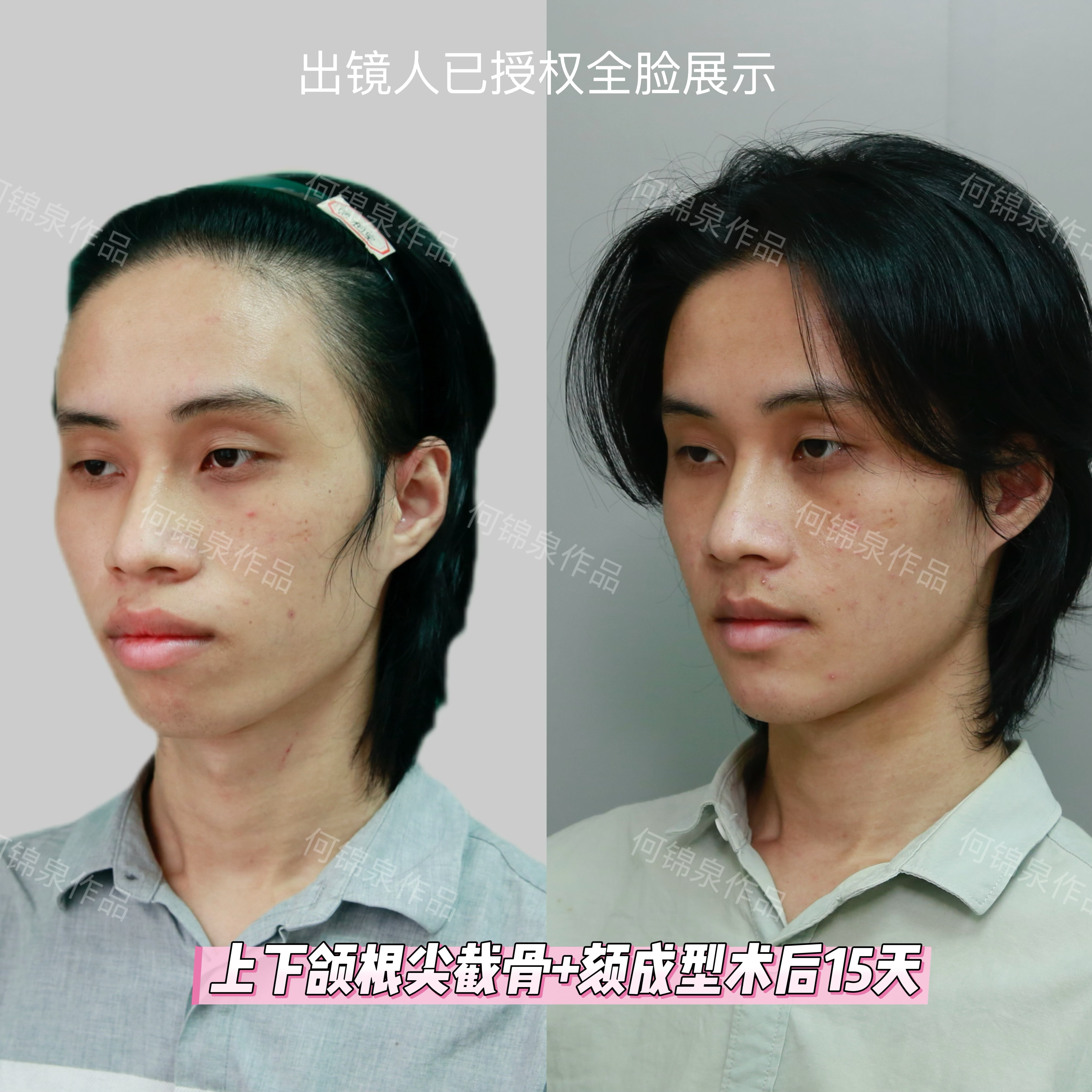 24岁男生凸嘴下巴后缩,改善后15天从土气男化身文艺男#正颌手术