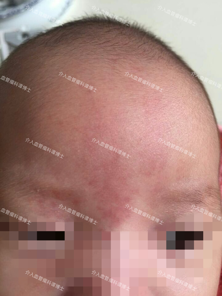我宝宝出生以来额头正中间有两条竖红印,到现在一直没有消