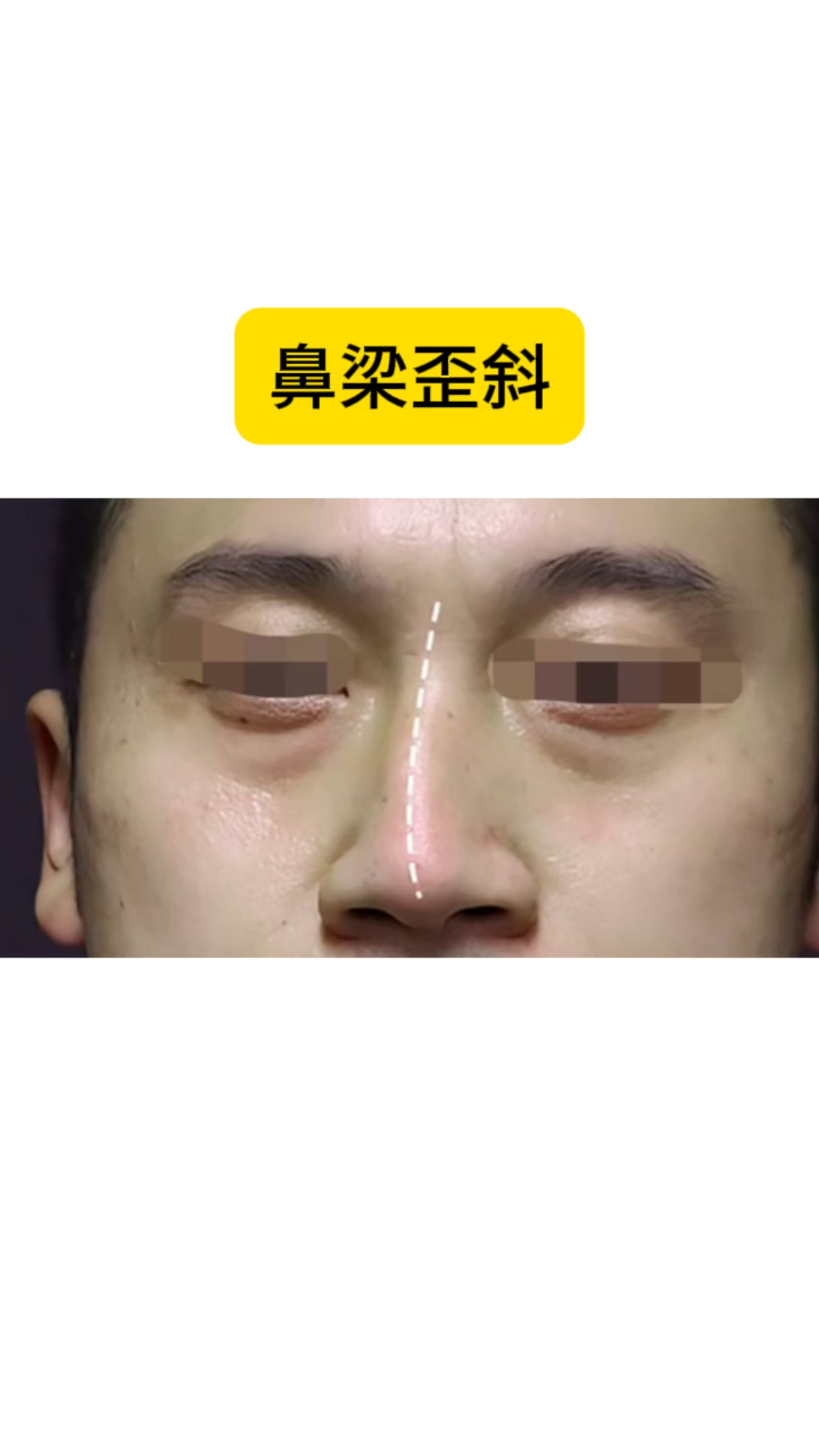 鼻梁歪斜有什么特殊含义