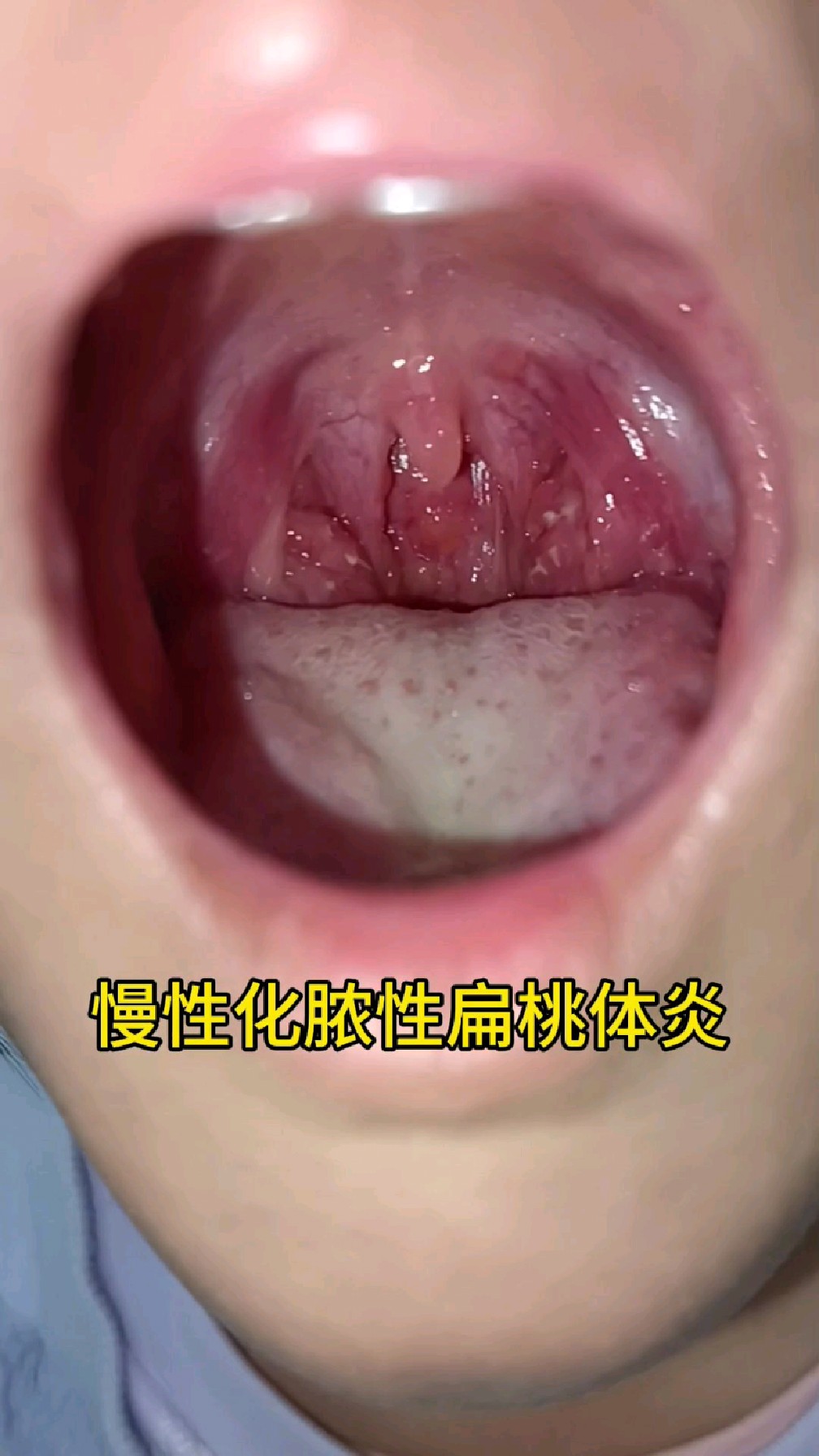 慢性化脓性扁桃体炎为什么感觉不到痛?让视频来解答