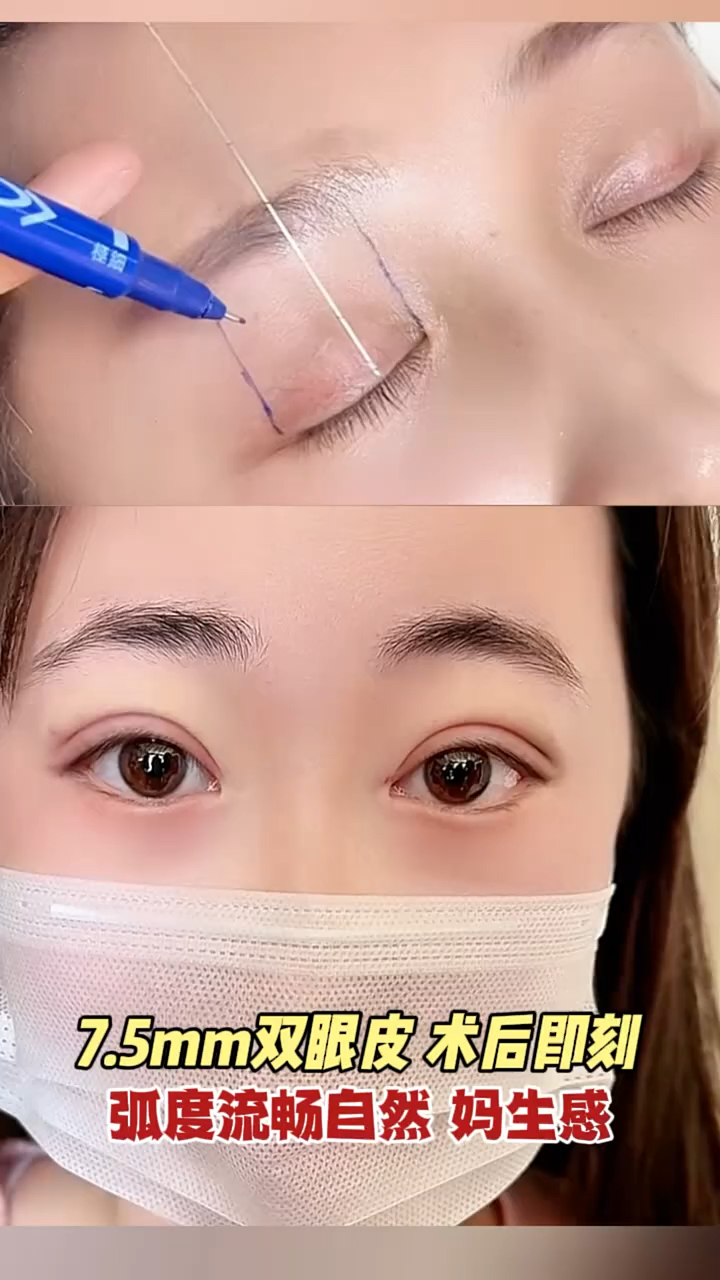 7.5mm双眼皮术后即刻,弧度流畅自然