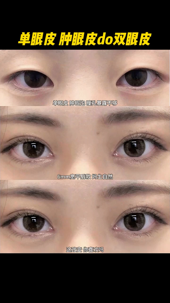 单眼皮肿眼皮修复双眼皮术后效果