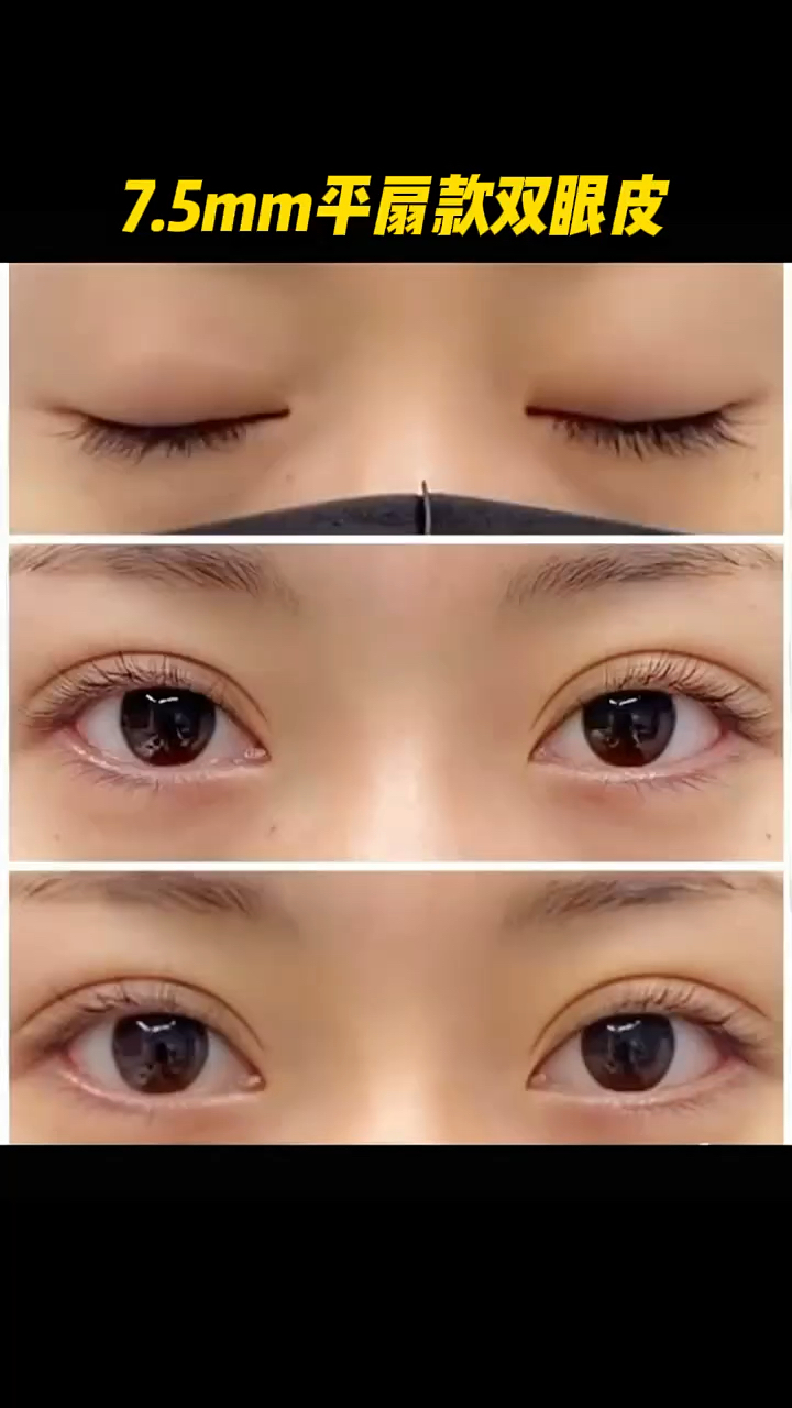 7.5mm平扇款双眼皮