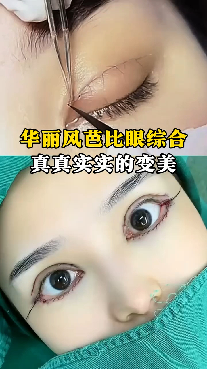 华丽风芭比眼综合,真真实实的变美