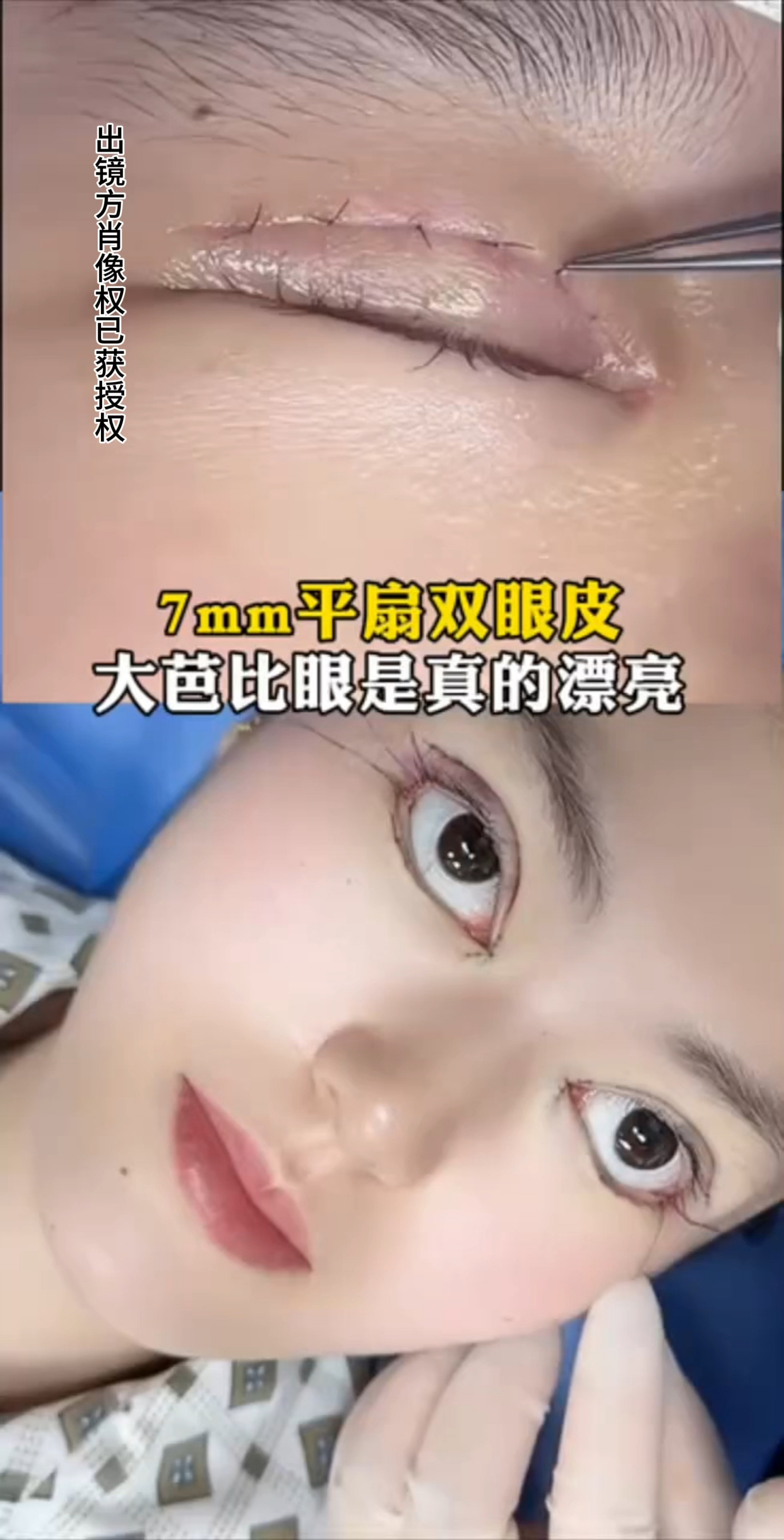7mm平扇双眼皮,大芭比眼是真的好看