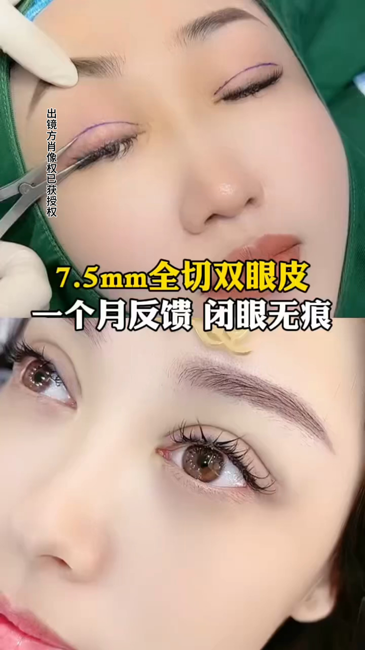 7.5mm全切双眼皮,术后一个月反馈