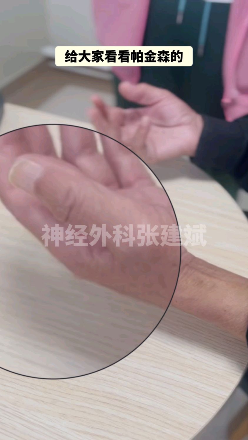 搓丸样震颤是帕金森病的典型表现之一