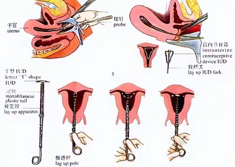"  陈医生耐心地解答了他们的疑问:  1. 上环可以避孕多久?