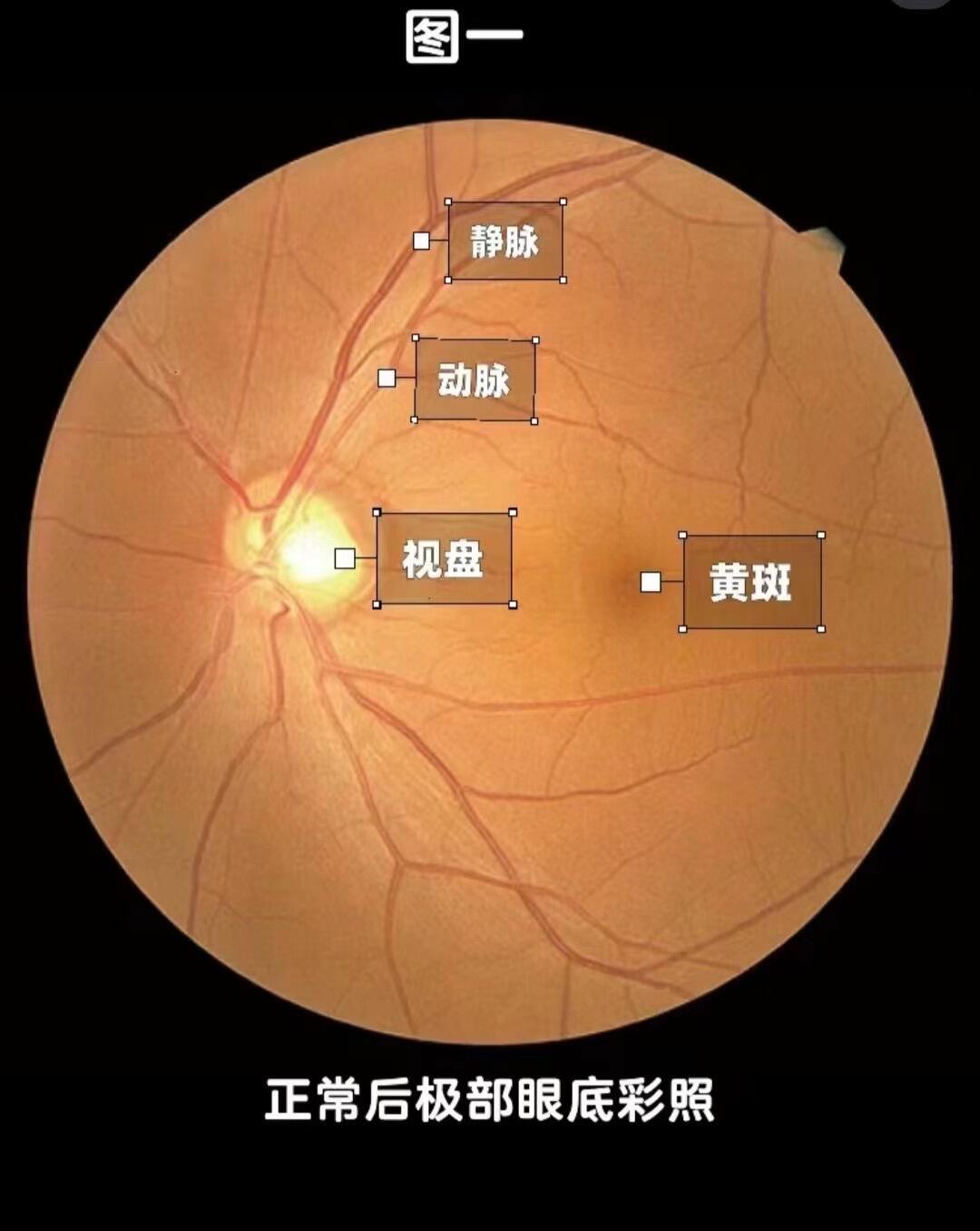 正常的眼底检查结果,你知道吗