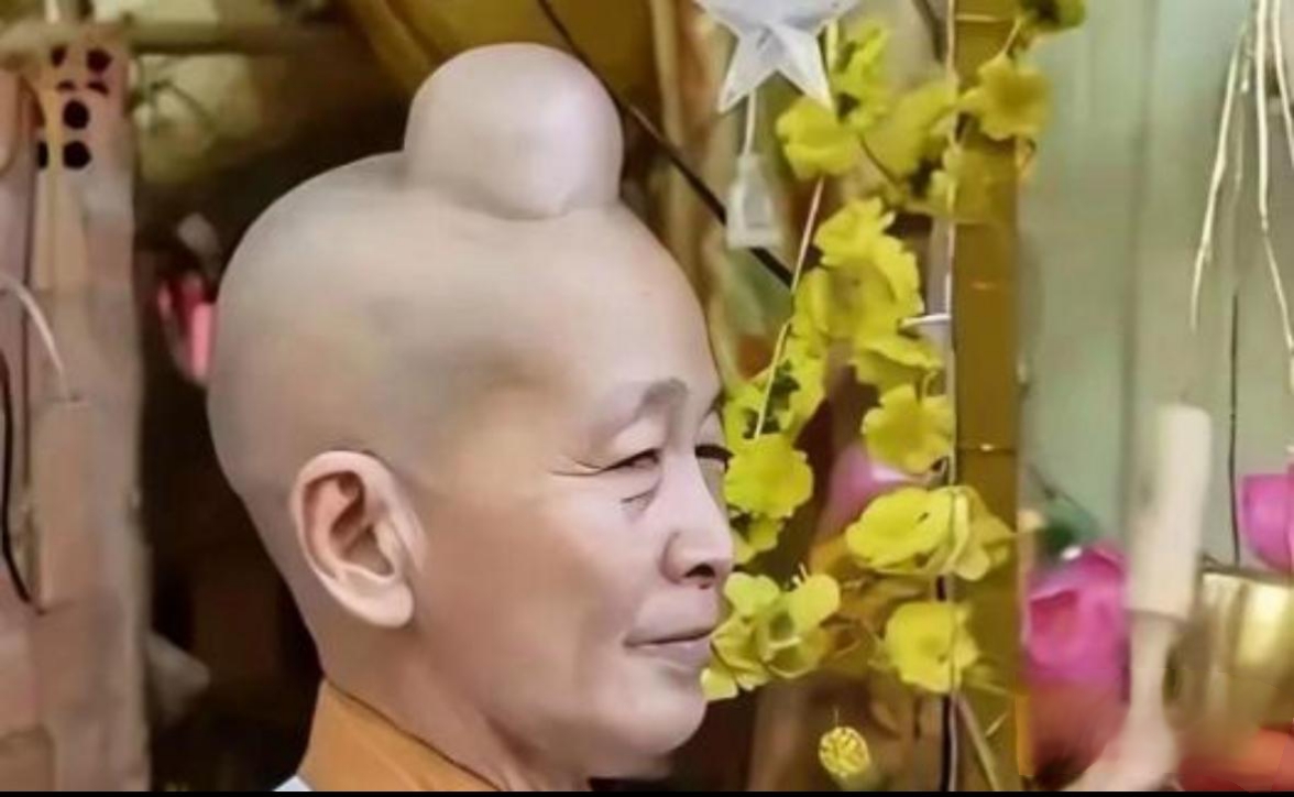 国内一女子,一出生头顶就长了一个跟佛祖一样的肉髻,一天,她联系医生