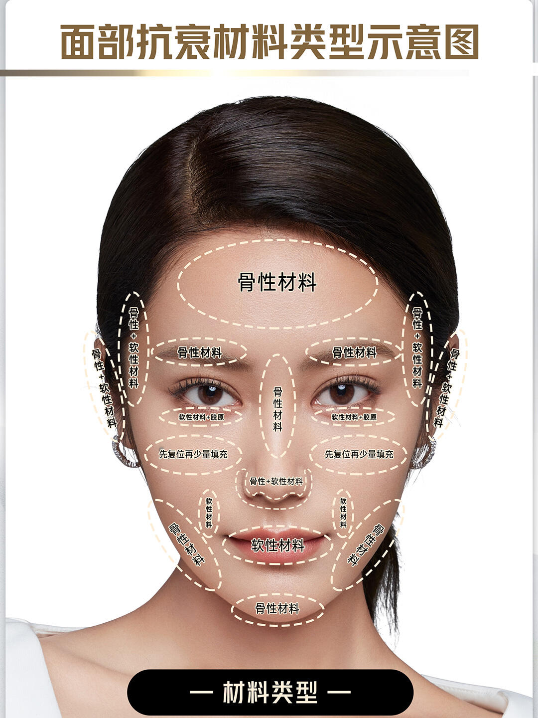 出现了眉尾垂,眼尾垂,苹果肌垂,口角垂以及整个面部软组织垮塌的问题