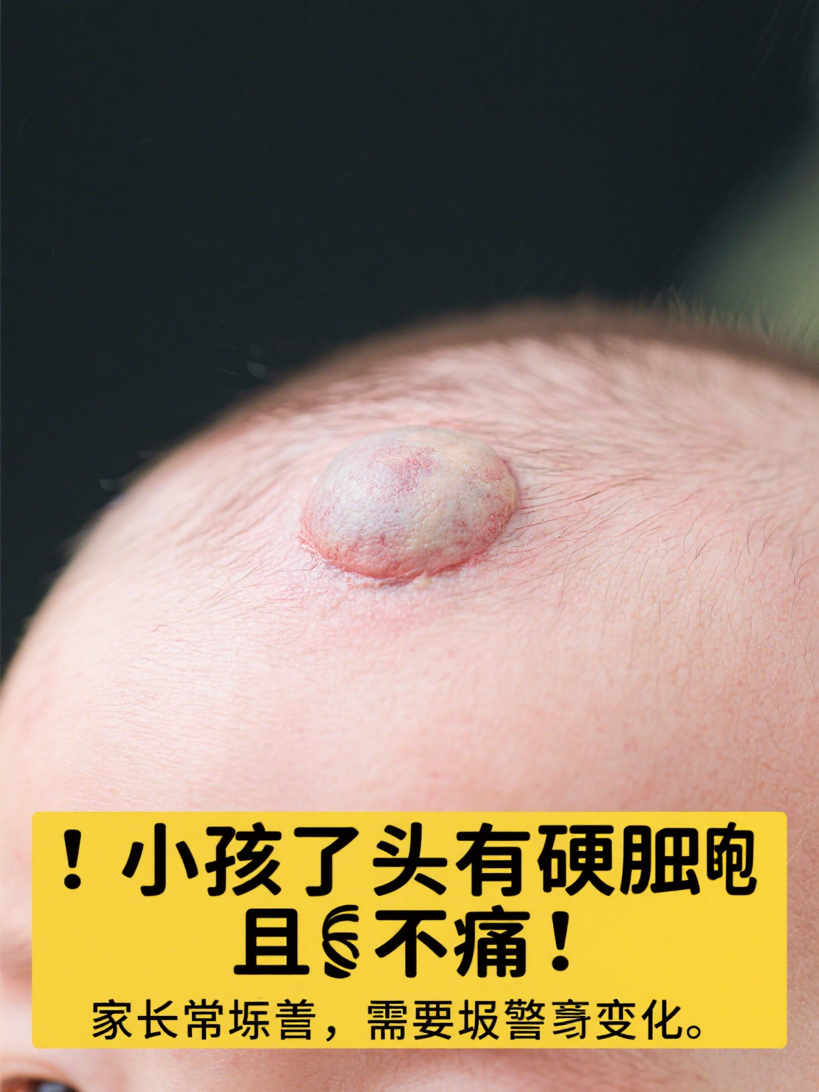 当家长发现小孩头顶有个硬包凸起且不痛时,往往会十分担忧