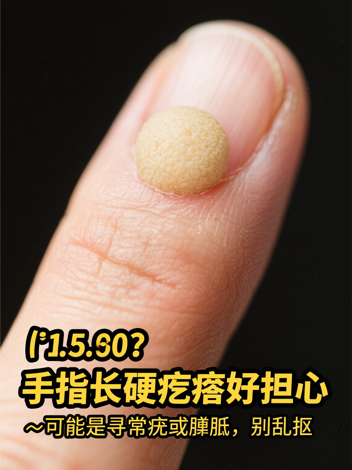 还会寻常疣手指硬疙瘩跖疣 手指手指长出硬硬的小疙瘩手上起肉刺是
