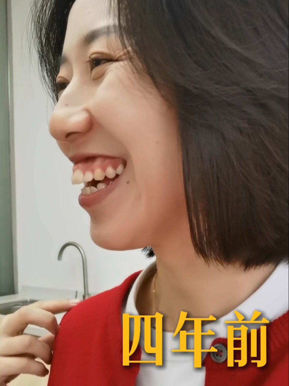 一个骨性凸嘴,龅牙女孩儿的4年!