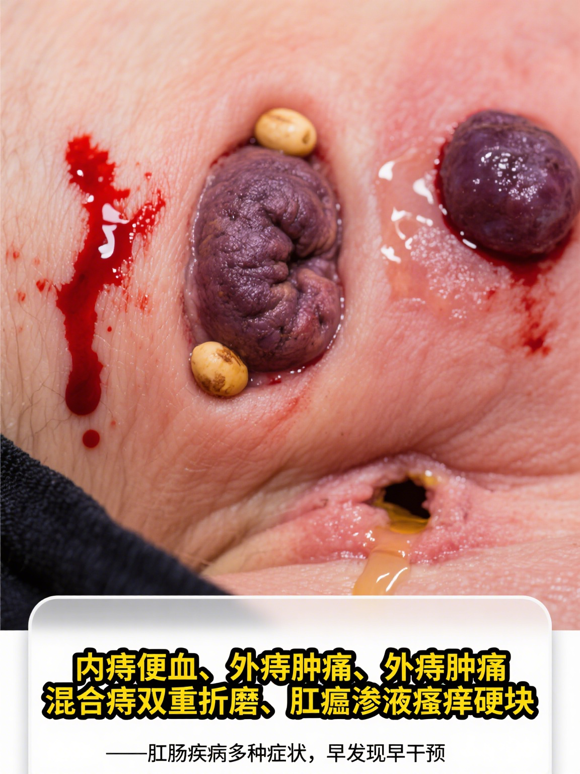 常见的肛肠疾病如痔疮,就像个"小恶魔",内痔常表现为便血,外痔则可能