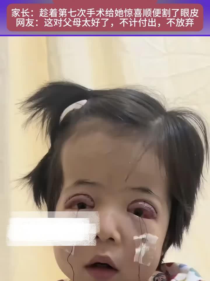 女孩患克鲁宗综合征发现眼睑下垂影响视力