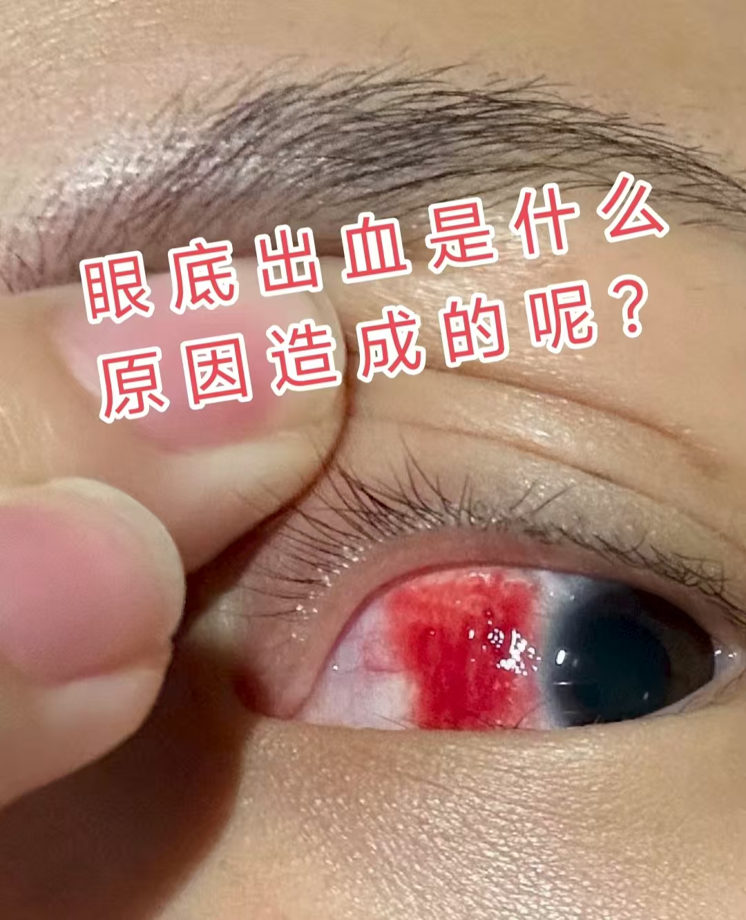 就像眼底的"血管堵车",血液流通不畅易引发破裂出血;糖尿病视网膜病变