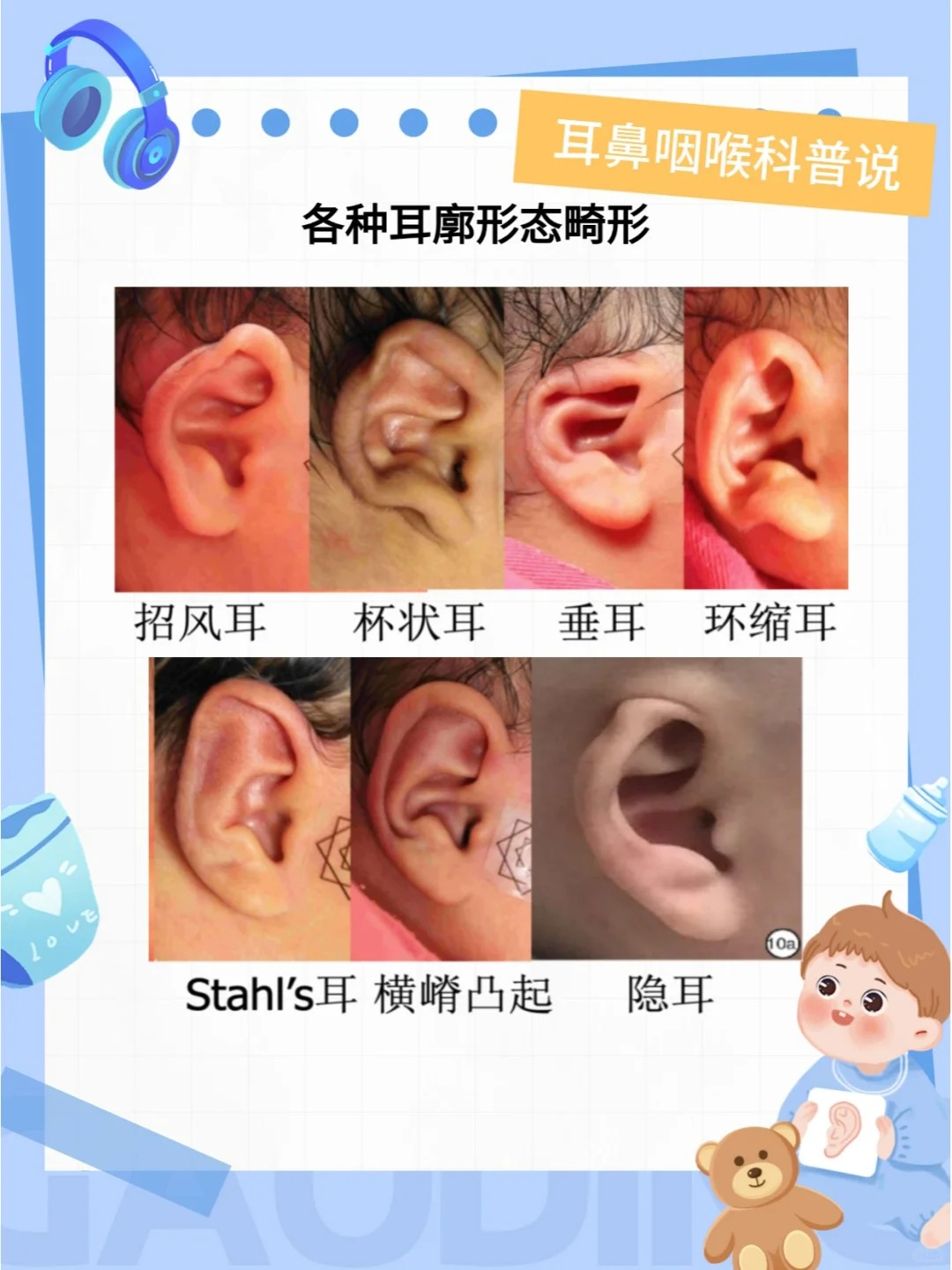 耳廓 耳廓是耳朵最显眼的部分位于头部两侧像一对精巧的小喇叭
