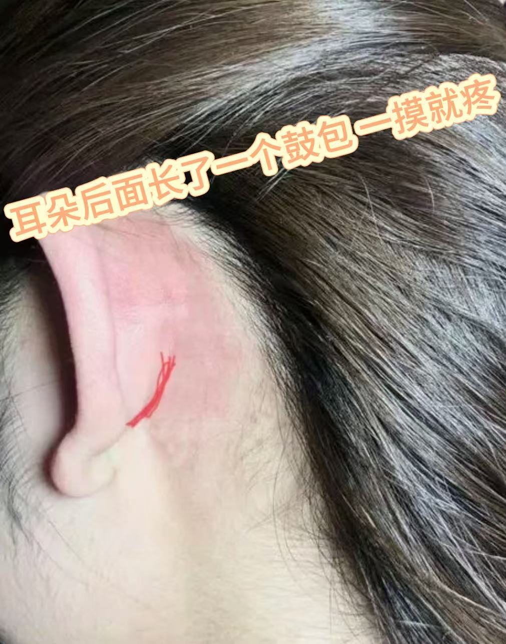 耳朵后面长了一个鼓包一摸就疼