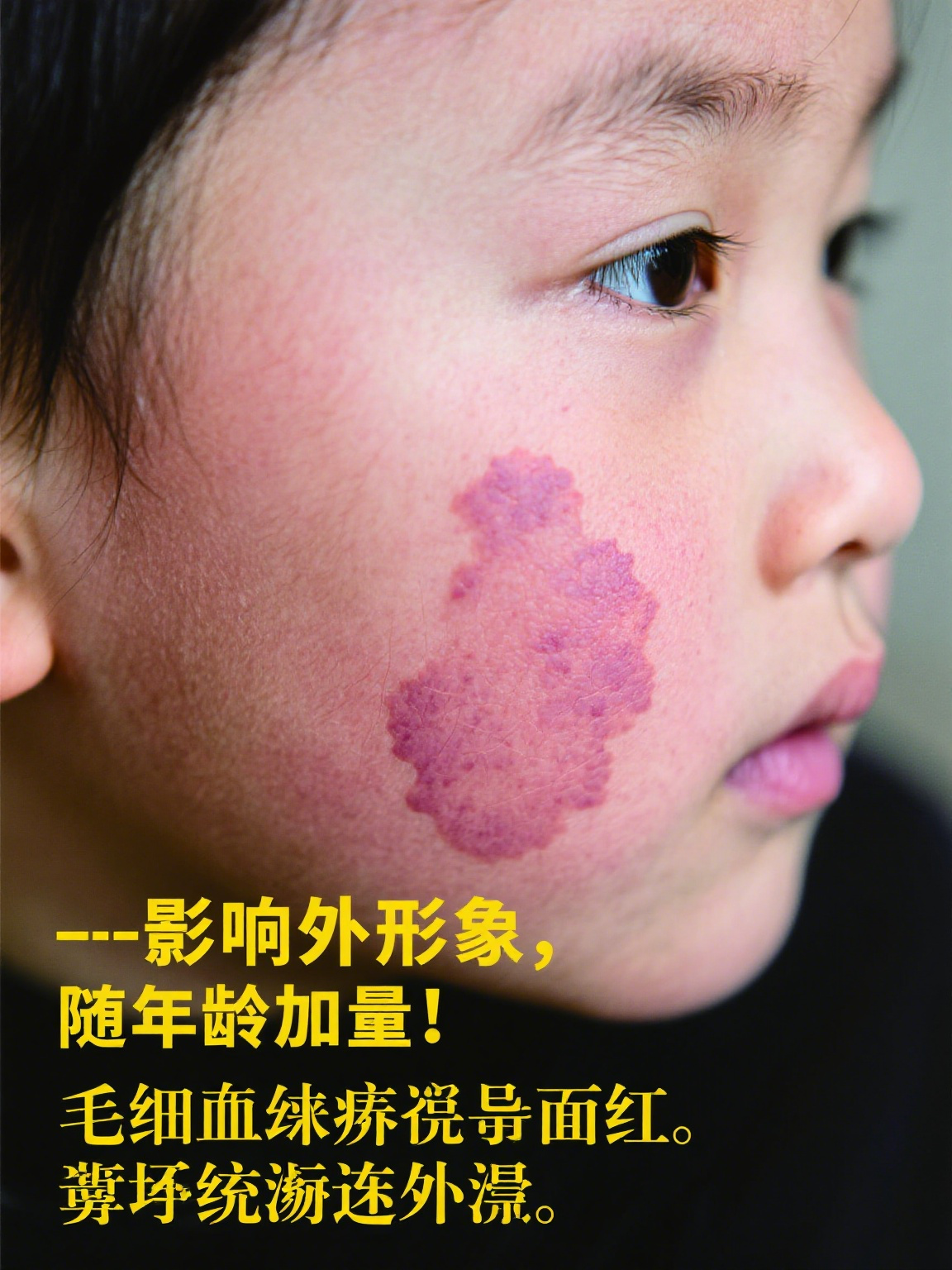 血管畸形图片 血管畸形是一种先天性血管发育异常,这些异常血管在图片