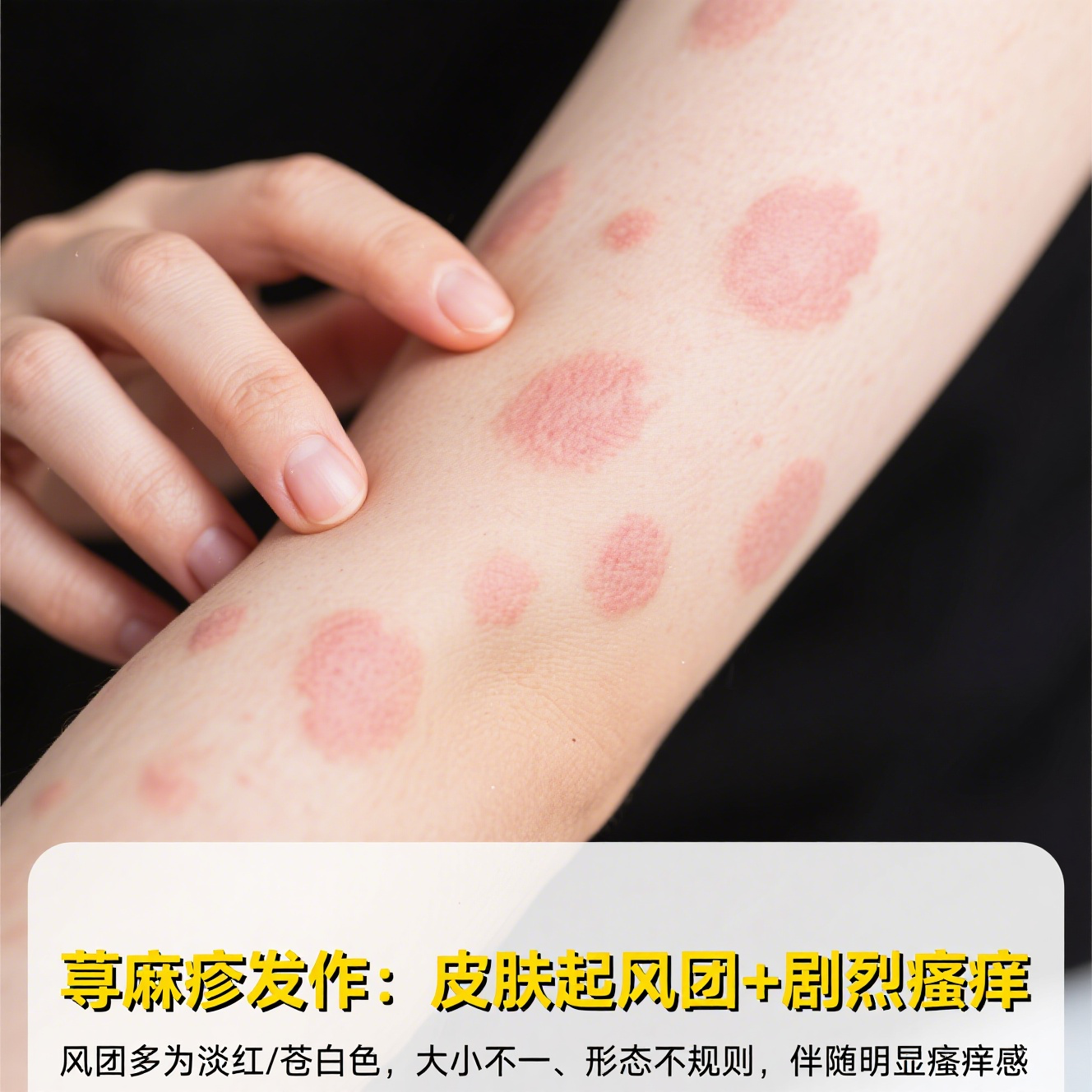 症状过敏性皮疹过敏性皮疹症状图片荨麻疹的图片和症状图片皮肤病图片