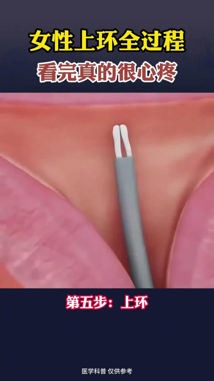 女性上环全过程