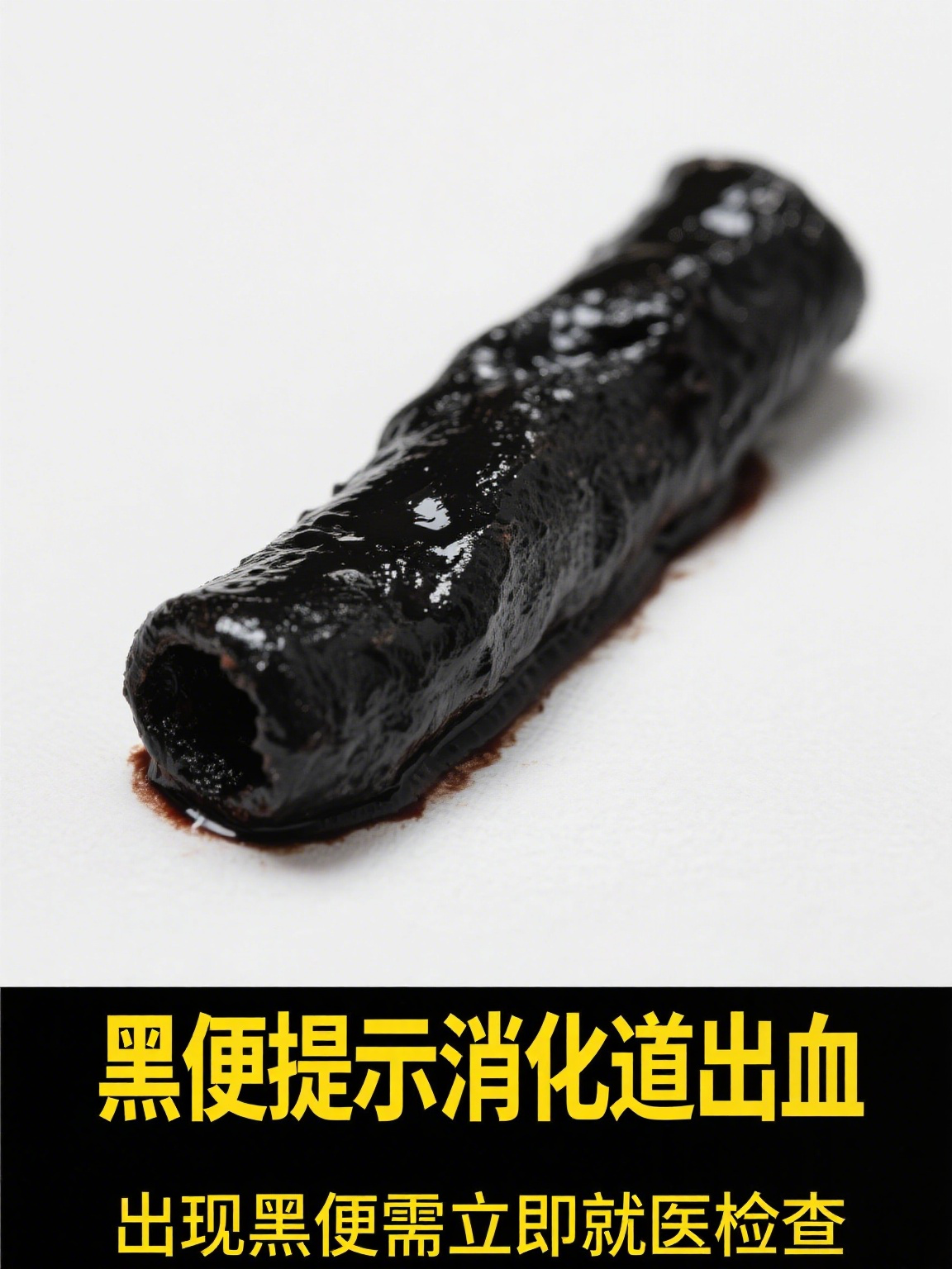 胃出血黑便最佳治疗方法 胃出血后出现黑便,意味着消化道存在出血情况