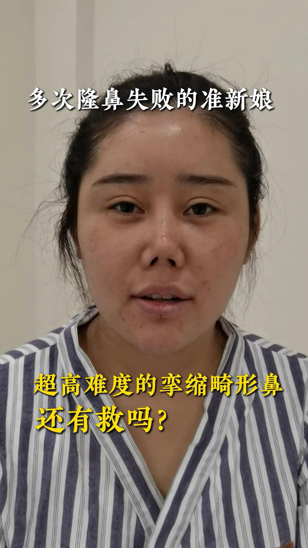 多次隆鼻失败的准新娘,超高难度的挛缩畸形鼻,还有救吗?