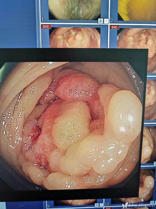 胃肠科十年大数据:这类职业人群患肠癌率超常人3倍!