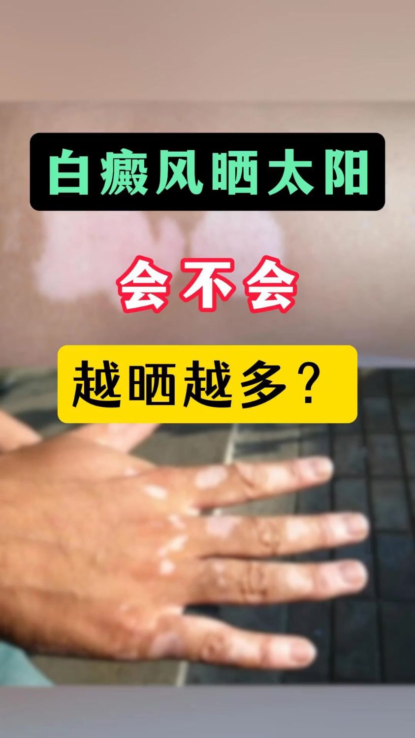 白癜风晒太阳会不会越晒越多?