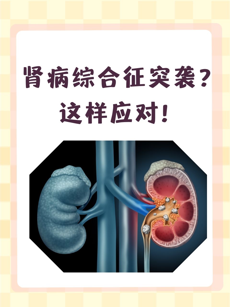 急性肾病综合征作为一种较为严重的肾脏疾病,常常让患者和家属感到