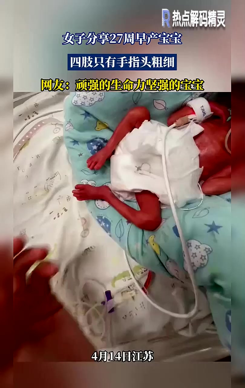 女子分享27周早产宝宝,四肢只有手指头粗细,网友:坚强的宝宝