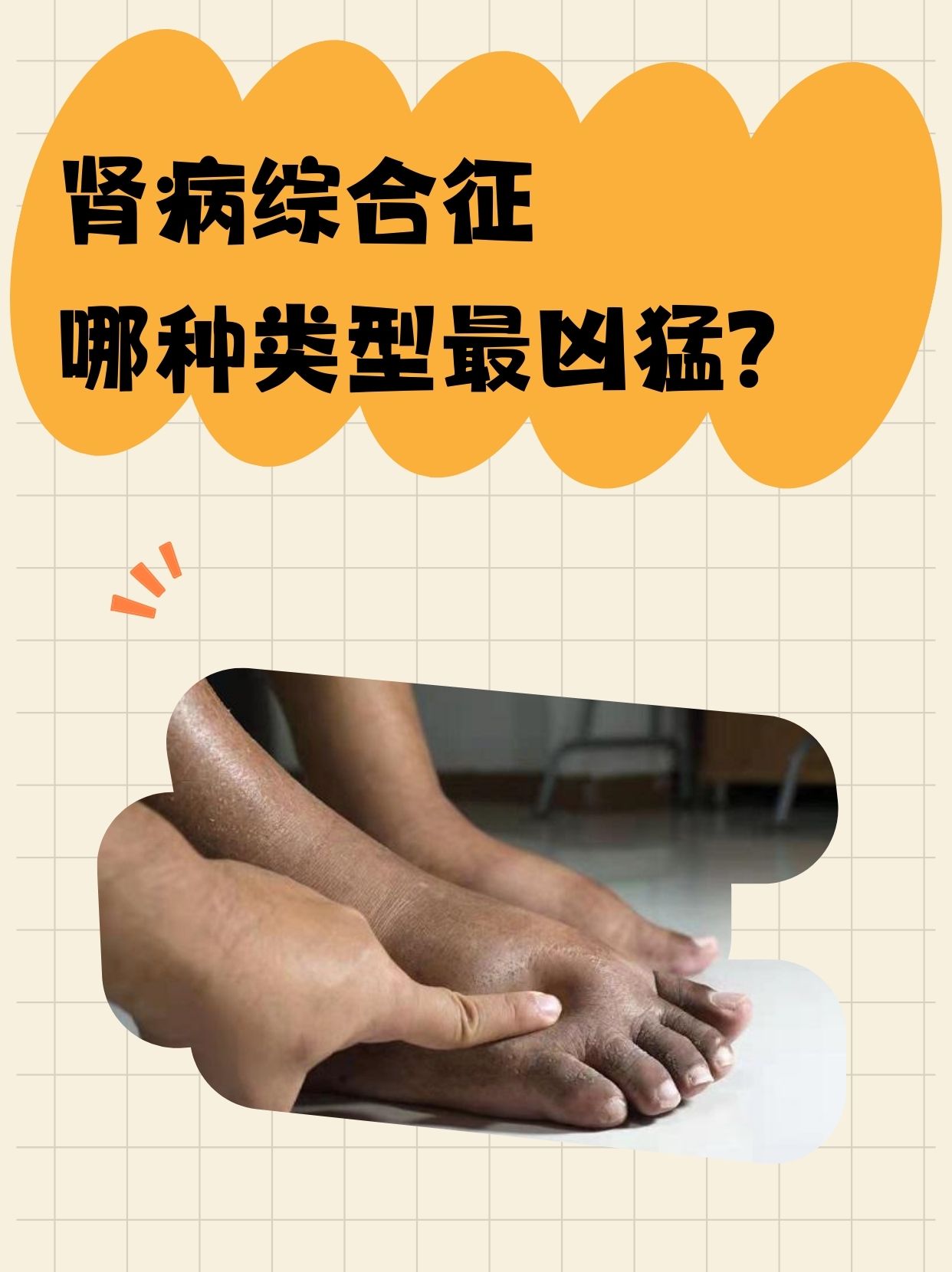 很多患者在得知自己患有肾病综合征后,往往想了解它有哪些类型,以及