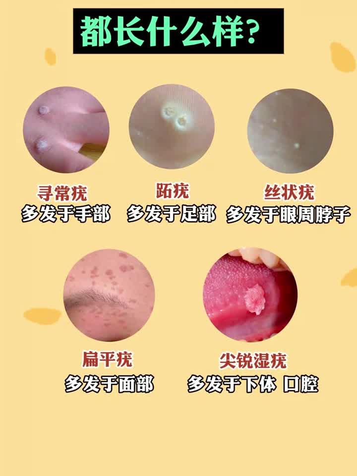 hpv感染的疣体,都长什么样?