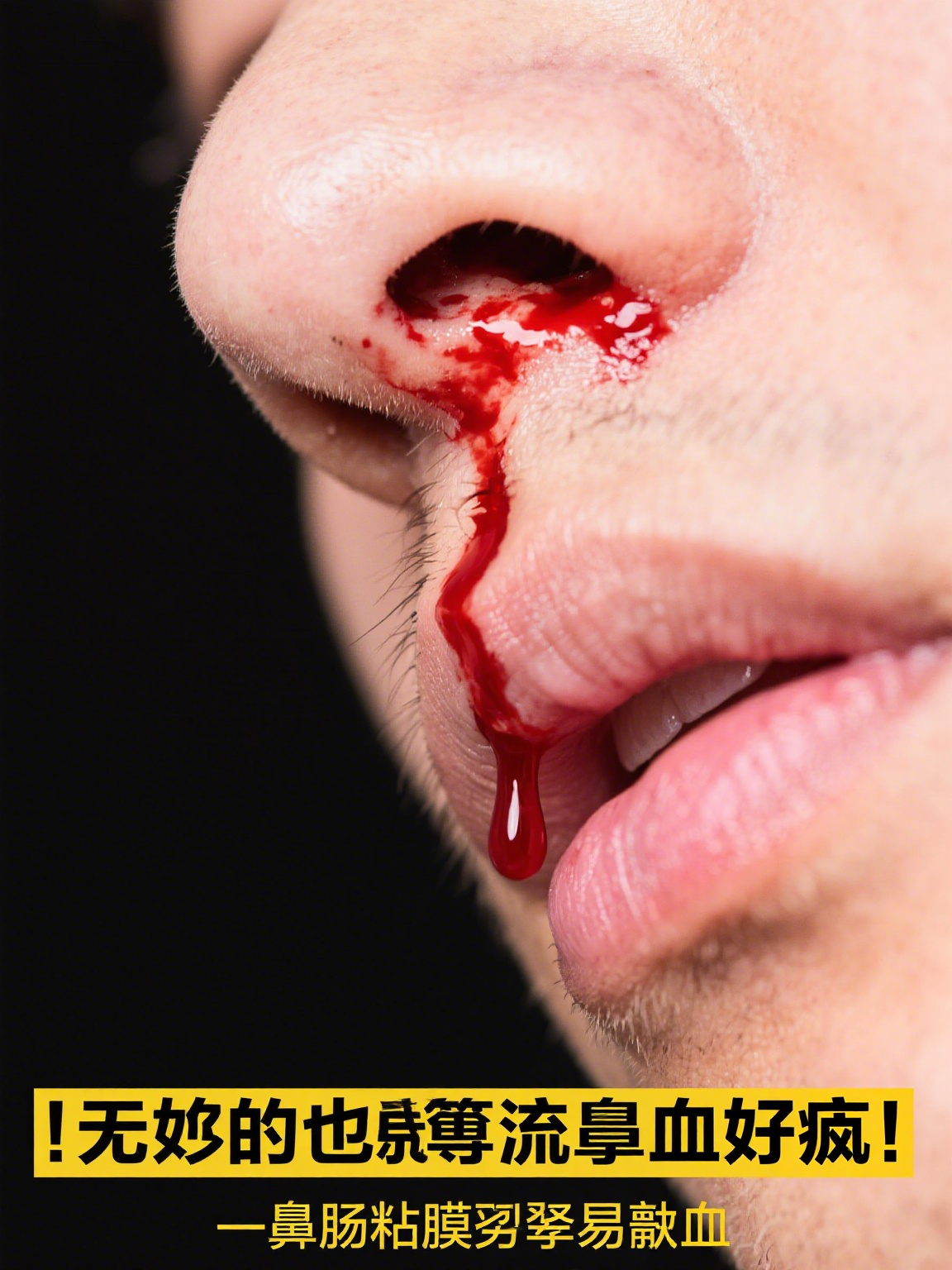 为什么会无缘无故流鼻血 为什么会无缘无故流鼻血