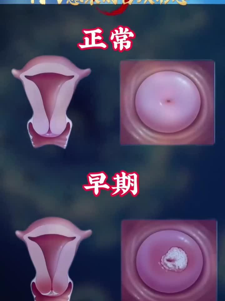 hpv感染的宫颈形态