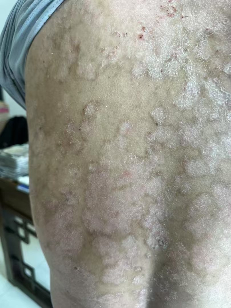 平凉牛皮癣医院：揭开治疗背后的真相