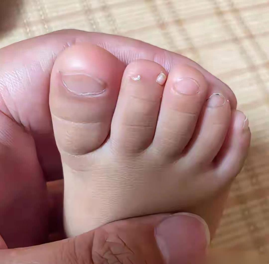 我家宝宝的五只脚趾头上怎么长了六个指甲,这不会产生什么不良影响吧?