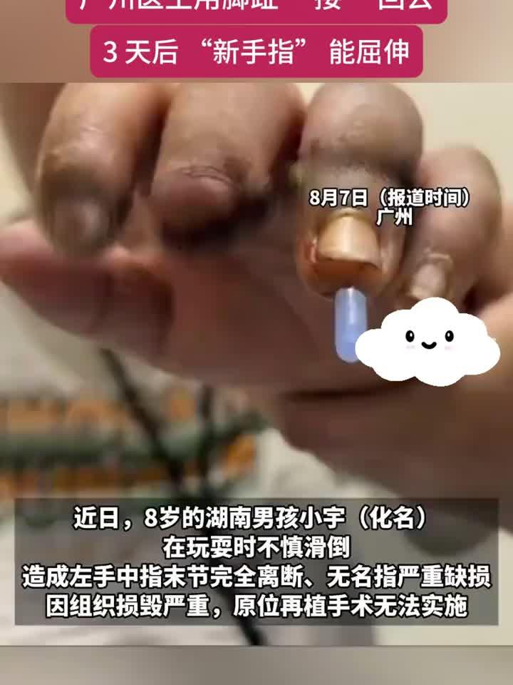 8岁男孩玩耍时手指断了 广州医生用脚趾"接"回
