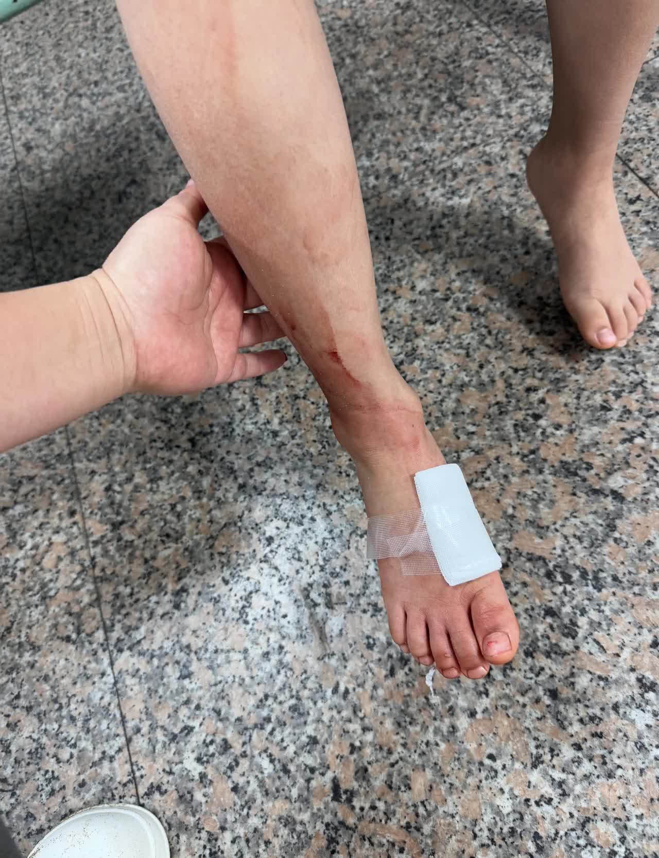 好走路把脚崴开刀脚被地库卡住了小孩被快递砸到脚小孩腿上打钢钉图片