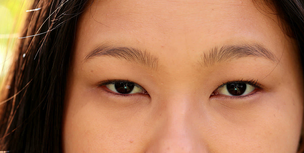 眼睑外翻:当眼睛的"守护者"失守 眼睑外翻是一种常见的眼部疾病,耸乔