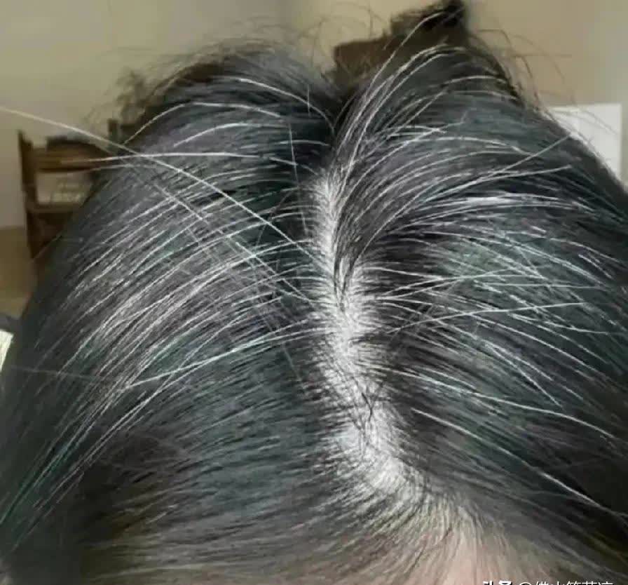 男生少白头是肾不好吗为什么在线 男生少白头是肾不好吗为什么在线