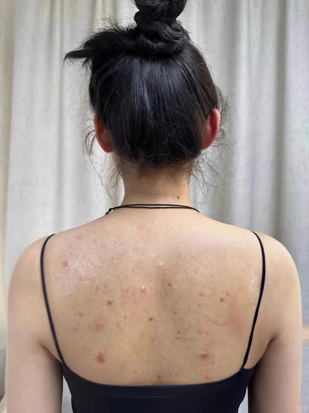 之前我的后背那可真是惨不忍睹呀,密密麻麻的痘痘全占满了