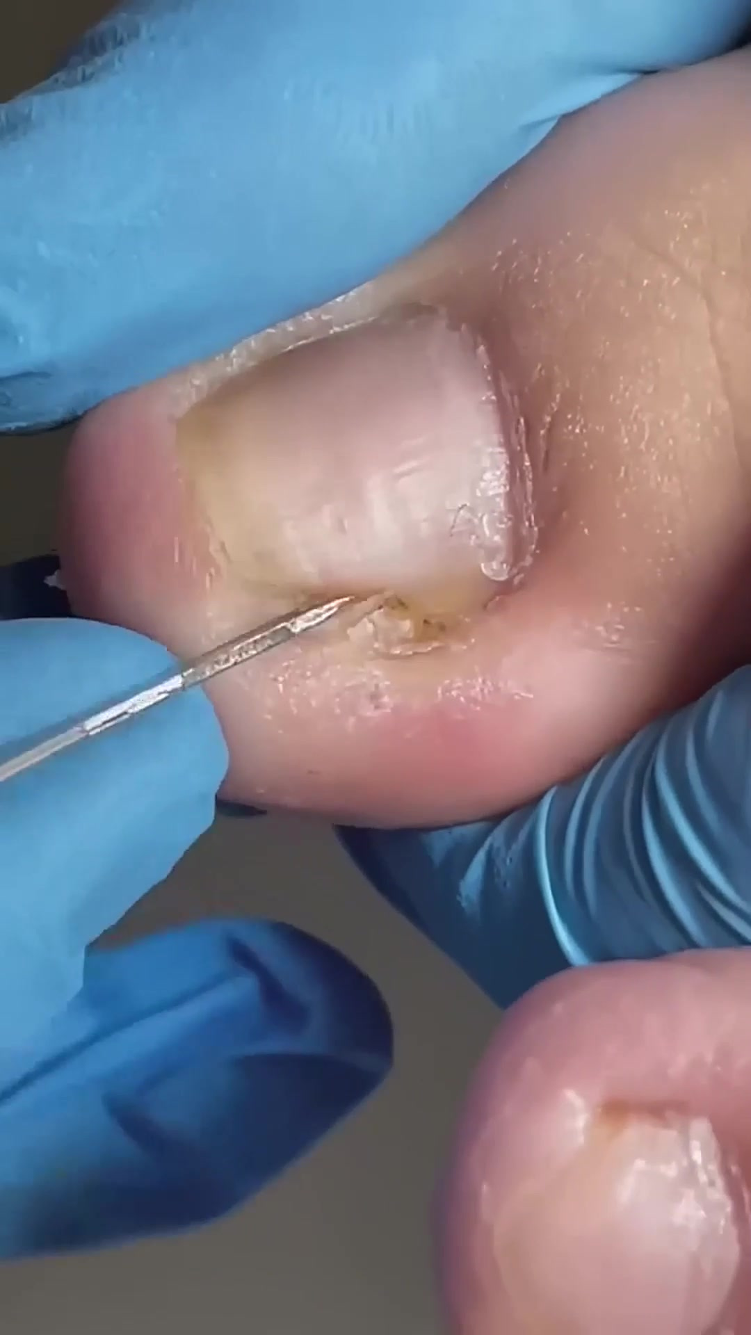 下饭视频,你知道甲沟炎拔完什么样子吗