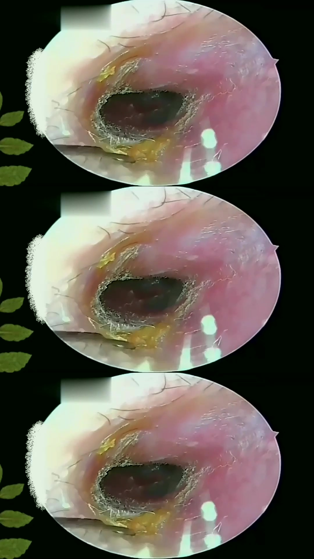 耳道霉菌干片;把这一大块完整的夹出来