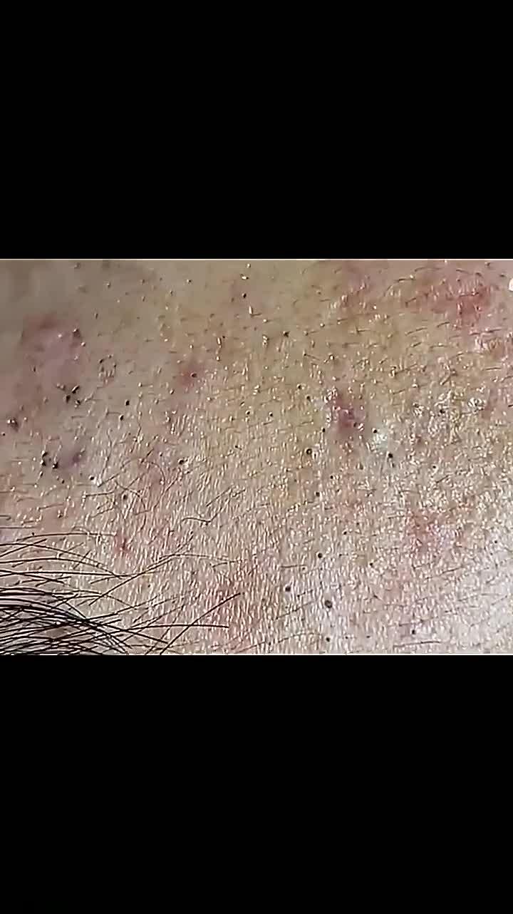 祛闭口粉刺祛闭口痘痘