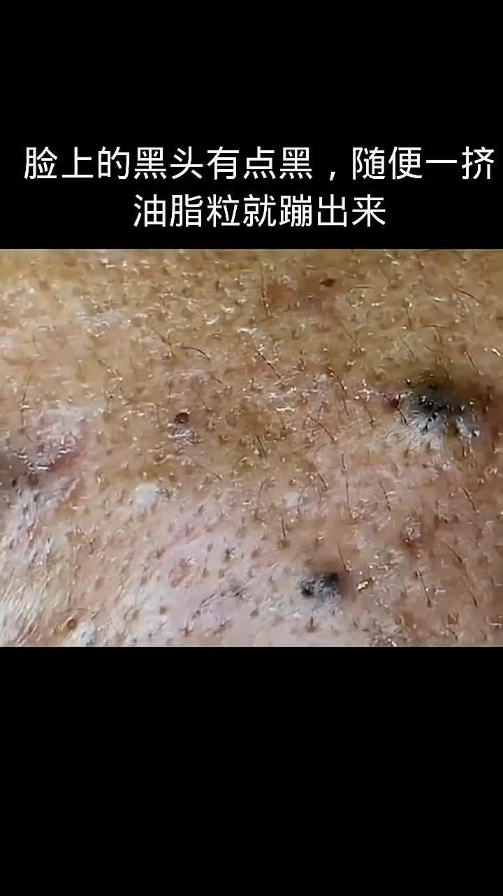 脸上痘痘挤出螨虫图图片