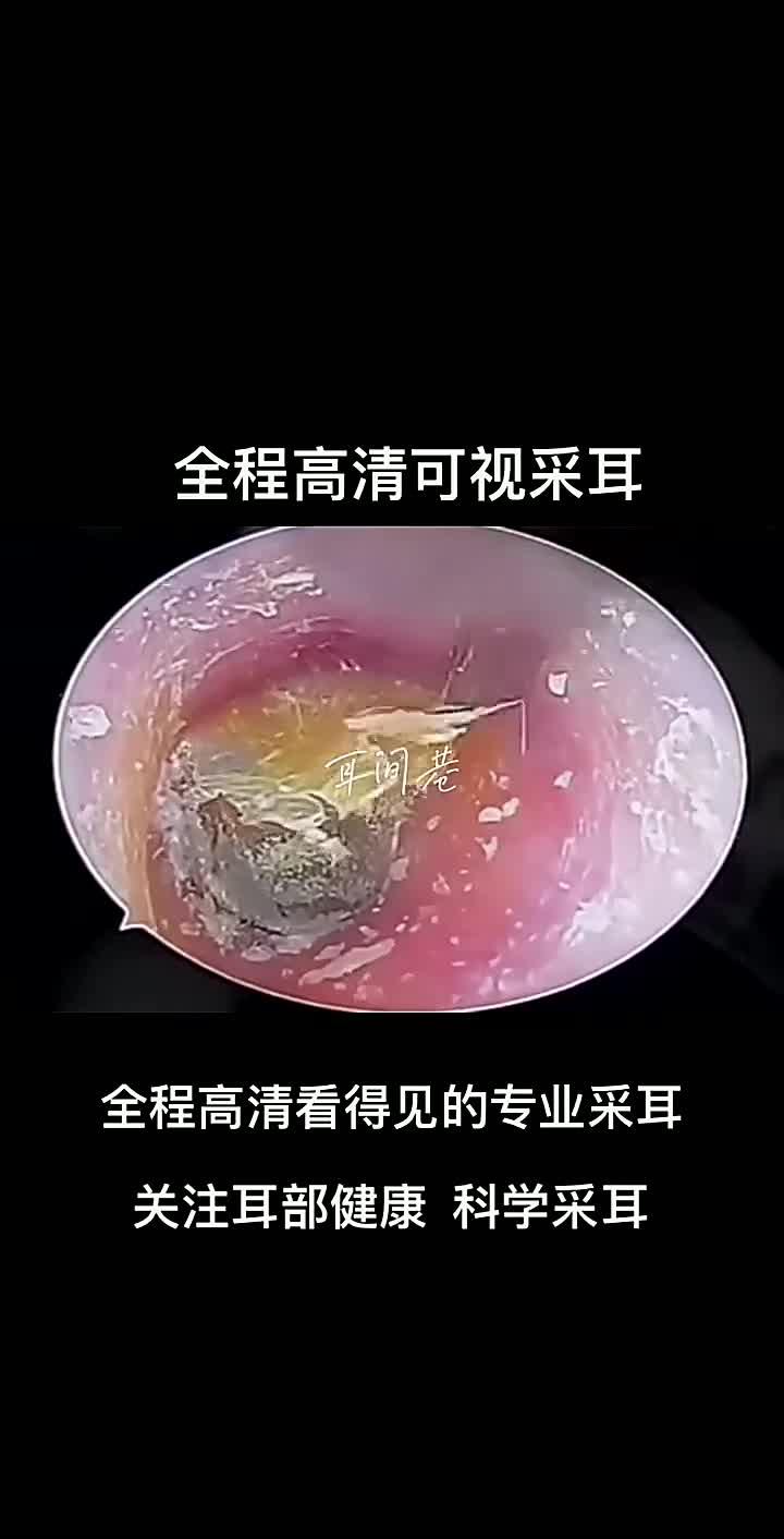 耳疼10秒止疼法最快最好视频=耳疼10秒止疼法最快最好视频耳朵发炎阿莫西林有用吗