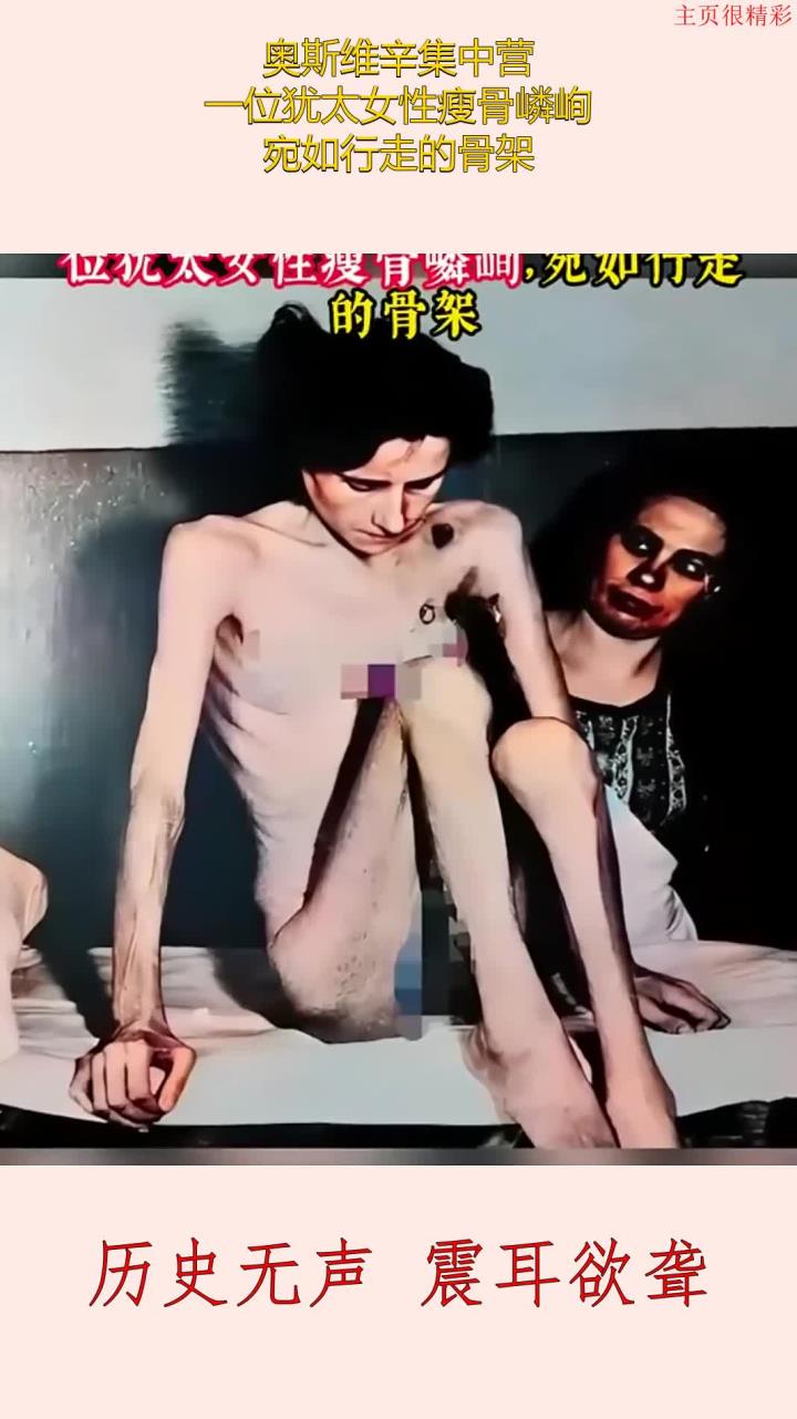 奥斯维辛集中营,一位犹太女性瘦骨嶙峋,宛如行走的骨架