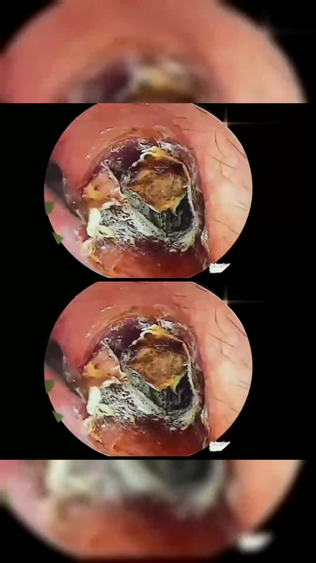 耳道霉菌干片,把这一层完整的拔出来!